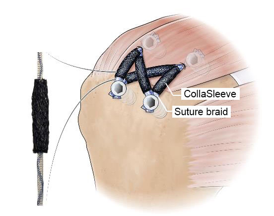 CollaSleeve® for a Rotator Cuff Repair slides over the suture braid.
